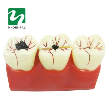 1 vnt Odontologinės Medžiagos Lab 4 Kartus Ėduonies Demontavimas Modelis dantų Protezų Ligos Dantys Modelis Klinika Odontologas