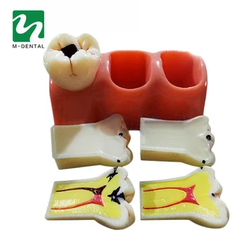 1 vnt Odontologinės Medžiagos Lab 4 Kartus Ėduonies Demontavimas Modelis dantų Protezų Ligos Dantys Modelis Klinika Odontologas